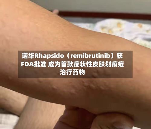 诺华Rhapsido（remibrutinib）获FDA批准 成为首款症状性皮肤划痕症治疗药物